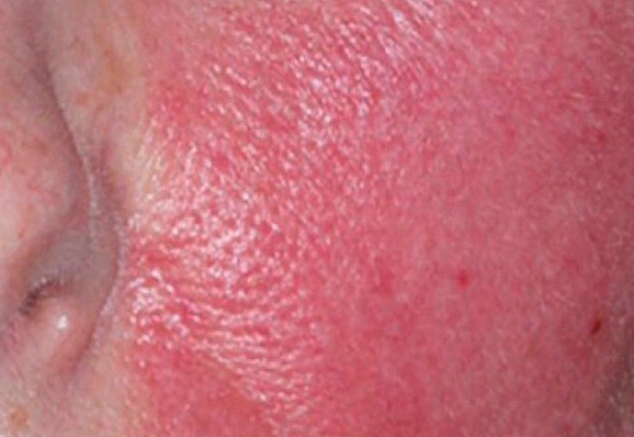 Rosacea-patient-2-photo-before-