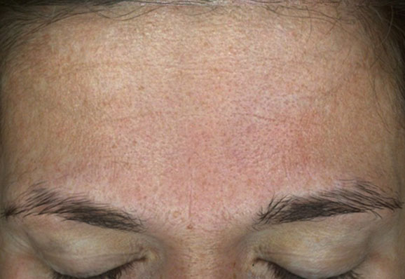 after-melasma3-protocole-renophase-(1)