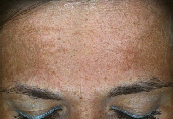 before-melasma3-protocole-renophase-(1)