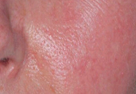 Rosacea-patient-2-photo-after- (1)