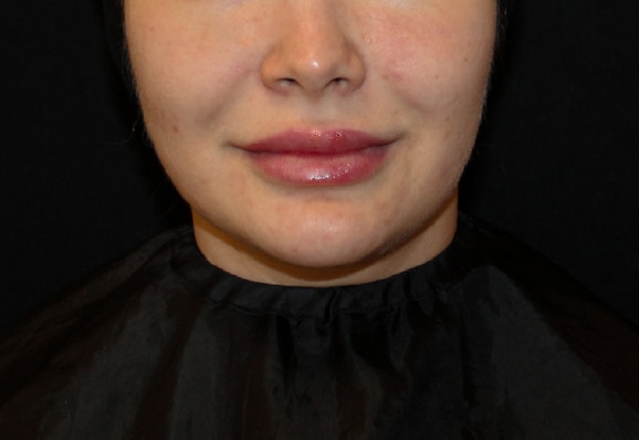 after-acne-renophase (1)