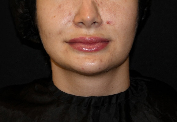 before-acne-renophase (2)