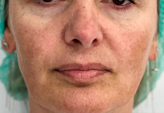 before-melasma-krenar (1)